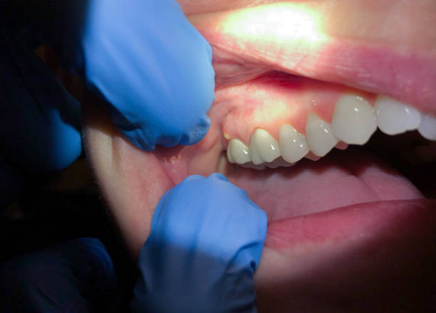 Best Broken or Cracked Tooth Emergency Dentist in Fresno, TX