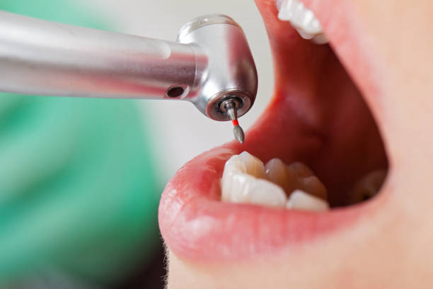 Best Emergency Dentist for Lost Fillings or Crowns in Fresno, TX